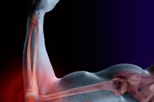 Signs of a Bone Spur in Elbow