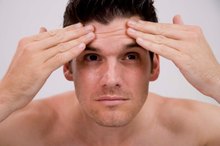 How to Treat Acne With Hydrocortisone