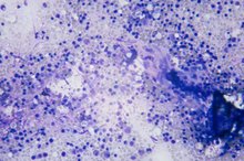 Signs & Symptoms of Bone Marrow Disease