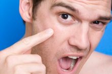 How to Remove Embedded Whiteheads