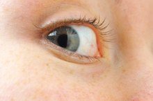 White Bump on the Inside of the Eye