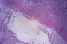 Gastroparesis as a Cause of Vitamin B-12 Deficiency