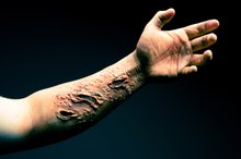 Salicylic Acid for Scar Removal
