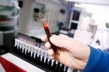 What Are the Causes of Low IgG and IgM?