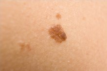How to Remove a Mole Naturally