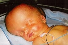 How to Determine Hydrocephalus Life Expectancy