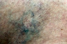 How to Get Rid of Broken Blood Vessels