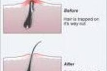 Popping Ingrown Hairs