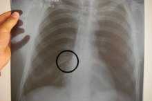 How Does a Broken Rib Heal?