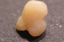 Plaque Build-Up in Throat: Is it Possible?