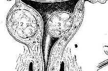 How to Shrink Fibroid Cysts Naturally