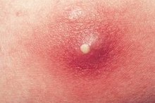 How to Treat a Boil Under an Arm
