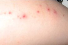 How to Diagnose a Skin Rash