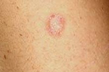How to Use Bleach to Cure Ringworm