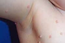 How to Remove Skin Tags with Tea Tree Oil