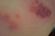 How to Prevent the Spread of Shingles