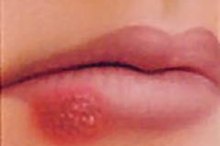 How to Cure Cold Sores Naturally With Salt