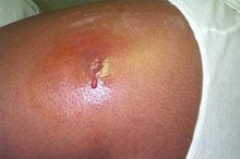 Symptoms of an MRSA Infection on the Face