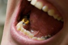 How to Cement a Dental Crown Without the Dentist