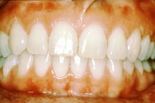 How to Treat Gum Disease With Vinegar