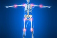 How to Know the Difference Between MS and Arthritis