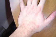 How to Treat Hives With Benadryl