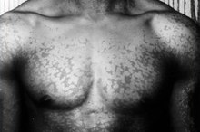 Skin Fungus That Causes White Spots