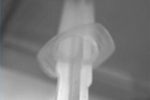 How to Unclog a G-Tube Feeding Tube