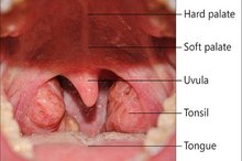 How Long Does Tonsillitis Last?