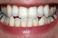 How Long Does it Take for Amoxicillin to Work on a Toothache?