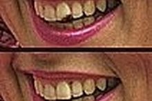 How to Make Homemade Porcelain Veneers pictures