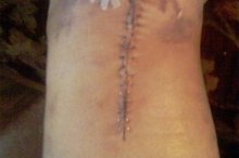 Knee Surgery & Hip Pain