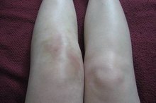 Treatment for Knee Effusion