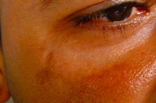 Treatment for an Old Scar Itch