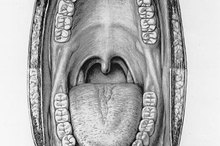 Frenectomy Side Effects