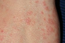 Early Scabies