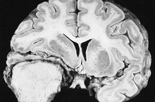 Diet to Shrink a Meningioma