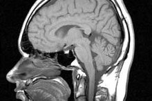 Supratentorial White Matter Disease