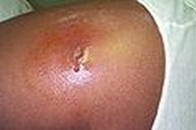 How to Get Rid of a Boil With a Bottle