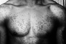 Stages of Tinea Versicolor