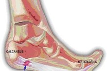 How to Cure Plantar Fasciitis Fast