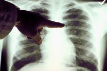 How to Spot Fluid on the Lung Symptoms