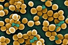 How to Recognize the Symptoms of MRSA Infection on the Scalp