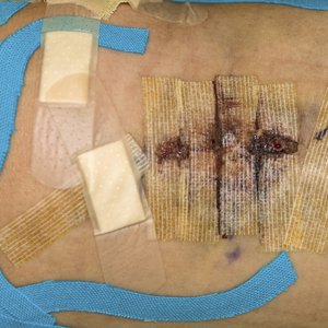 Scars After an ACL Repair