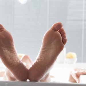 Reasons for Severely Cracked Heels