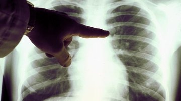How to Spot Fluid on the Lung Symptoms